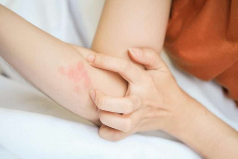 cbd psoriasi